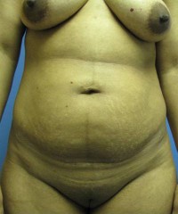 Abdominoplastia