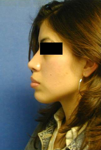 Cirugia Nasal