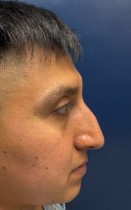 right side view before rhinoplasty