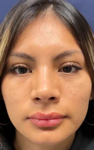 front view after rhinoplasty