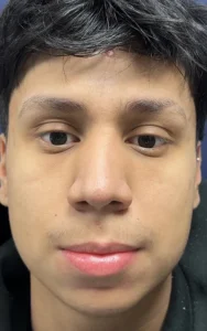 front view after male rhinoplasty