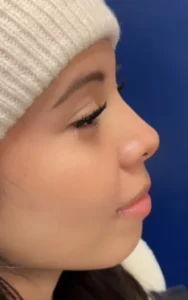 profile view after rhinoplasty