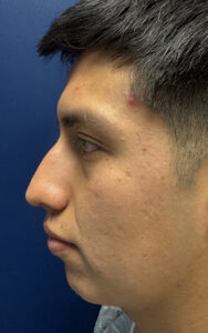 left profile view before rhinoplasty